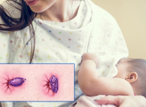 6 cách giúp giảm đau trĩ sau sinh hiệu quả cho các mẹ bỉm sữa.