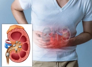 Sỏi thận có nguy hiểm không? Khi nào cần mổ sỏi thận?