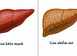 Gan nhiễm mỡ: 10 cách đối phó với gan nhiễm mỡ độ 1 đơn giản mà hiệu quả