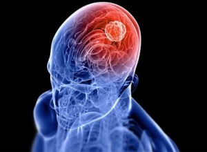 Nguyên nhân gây ung thư não và những điều người bệnh cần biết