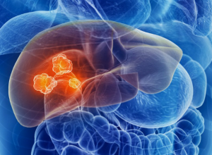 Ung thư gan di căn có chữa được không? Sống được bao lâu?