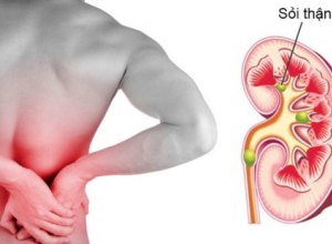Sỏi thận không đau có nguy hiểm không? Tìm hiểu ngay để biết