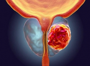 Bệnh ung thư tuyến tiền liệt có chữa được không? Tìm hiểu ngay để biết