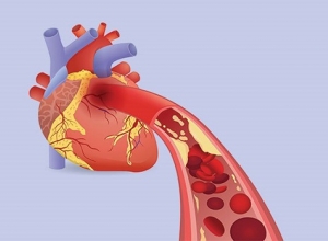 Bệnh thiếu máu cơ tim có chữa được không? Cách chữa như nào?