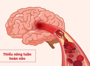 4 nguyên nhân gây thiểu năng tuần hoàn não tuyệt đối không được chủ quan.