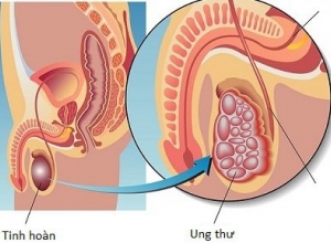Ung thư tinh hoàn có chữa khỏi được không? Điều trị như nào?
