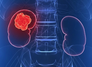 Ung thư thận: Khi nào thì cần gặp bác sĩ?