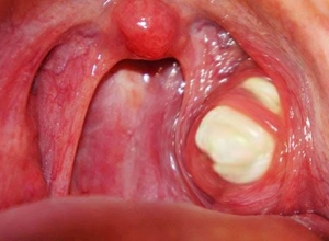 Thời gian ủ bệnh của ung thư vòm họng là bao lâu?