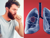 Ung thư phổi giai đoạn đầu: Làm sao để nhận biết?