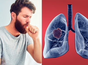 Ung thư phổi giai đoạn đầu: Làm sao để nhận biết?
