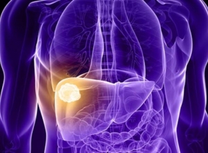 Nhận biết ngay 6 dấu hiệu ung thư gan trước khi quá muộn 