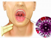 Một số yếu tố tiềm ẩn gây ung thư vòm họng, tuyệt đối không nên chủ quan.