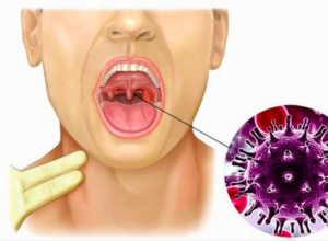 Một số yếu tố tiềm ẩn gây ung thư vòm họng, tuyệt đối không nên chủ quan.