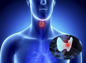 Làm cách nào để nhận biết sớm ung thư tuyến giáp giai đoạn đầu?