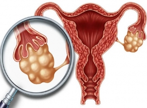 Ung thư buồng trứng: Nguyên nhân do đâu? Cách phòng ngừa như nào?