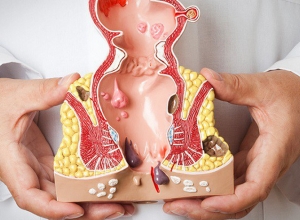 Ai là người dễ mắc phải ung thư hậu môn? Tìm hiểu ngay để biết