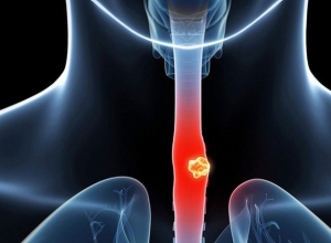 Ung thư thực quản: Đi khám nay nếu có 6 dấu hiệu dưới đây