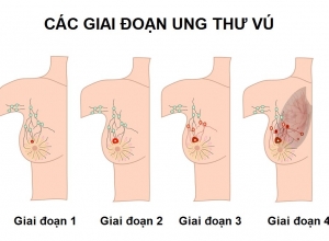 5 giai đoạn ung thư vú chị em phụ nữ cần phải biết 