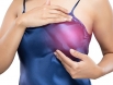 Dấu hiệu nào cảnh báo ung thư vú tái phát? Chị em tuyệt đối không nên chủ quan