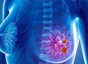 Cảnh báo 8 đối tượng có nguy cơ mắc ung thư vú cao nhất