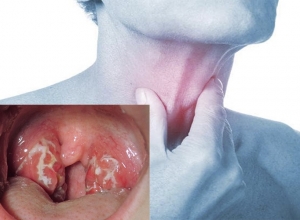 Ung thư vòm họng giai đoạn 2: Sống được bao lâu? Có chữa khỏi được không?