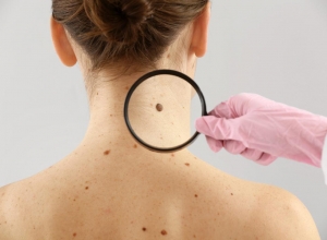 Top 9 vị trí ung thư da mà bạn không ngờ đến