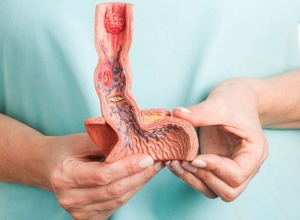 Ung thư thực quản giai đoạn đầu: Hiểu rõ để điều trị thành công