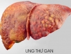 Cần làm gì khi nghi ngờ các triệu chứng của ung thư gan?