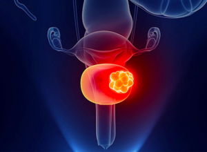 Cảnh báo: 5 nguyên nhân gây ung thư bàng quang đừng nên chủ quan