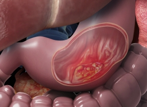 Dấu hiệu ung thư trực tràng giai đoạn đầu: Nhận biết ngay để điều trị kịp thời 