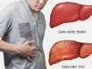 Ung thư gan nên ăn gì? Một số thực phẩm người bệnh nên bổ sung ngay vào thực đơn hàng ngày. 