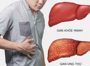 Ung thư gan nên ăn gì? Một số thực phẩm người bệnh nên bổ sung ngay vào thực đơn hàng ngày. 