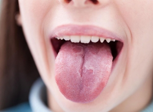 Ung thư lưỡi: 10 dấu hiệu tuyệt đối không nên bỏ qua