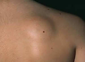 Ung thư mô mỡ: Làm sao để phát hiện các triệu chứng sớm của bệnh?