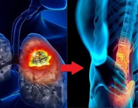 Phục hồi chức năng cho người bệnh sau phẫu thuật thay khớp háng.