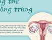 Ung thư buồng trứng: Hiểu nguyên nhân để biết cách phòng ngừa