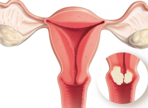 Ung thư cổ tử cung giai đoạn 3 sống được bao lâu?