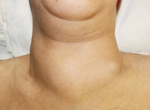 Làm thế nào để nhận biết các dấu hiệu ung thư tuyến giáp giai đoạn cuối?