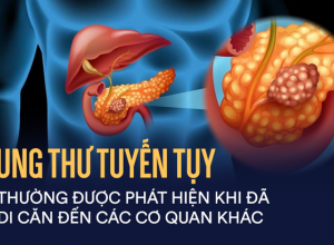 Ung thư tuyến tụy: Có những biện pháp điều trị nào?
