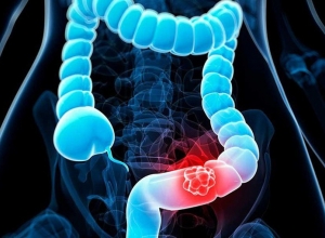 Ung thư trực tràng: Có những phương pháp điều trị nào?