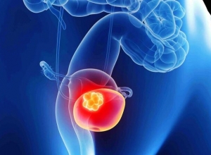 5 nguyên nhân phổ biến gây ung thư bàng quang, có thể bạn chưa biết