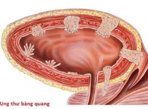 Đối tượng nào có nguy cơ mắc ung thư bàng quang nhất?