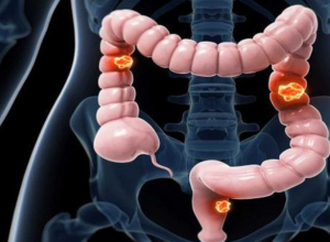 Ung thư đại tràng có chữa khỏi được không?