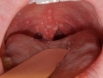 Ung thư vòm họng có chữa được không