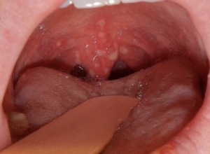 Ung thư vòm họng có chữa được không