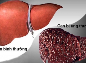 Các triệu chứng ung thư gan giai đoạn muộn cần đặc biệt chú ý