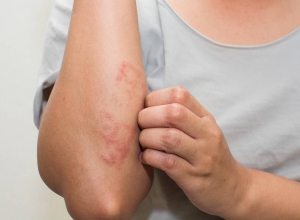 Thực phẩm nào giúp phòng ngừa ung thư da?