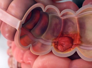 Các yếu tố nào ảnh hưởng đến tiên lượng ung thư đại tràng?