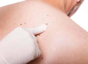 Những việc nên làm ngay để phòng ung thư da