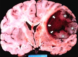 Cảnh báo những ảnh hưởng của ung thư não tới người bệnh.